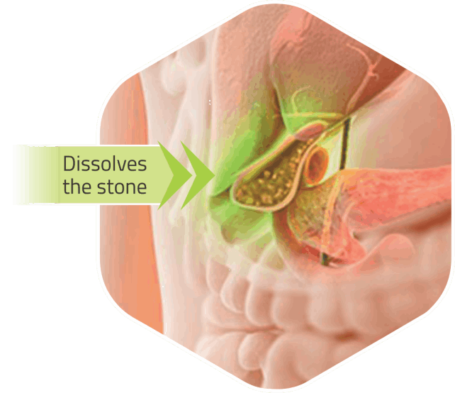 Gallstone